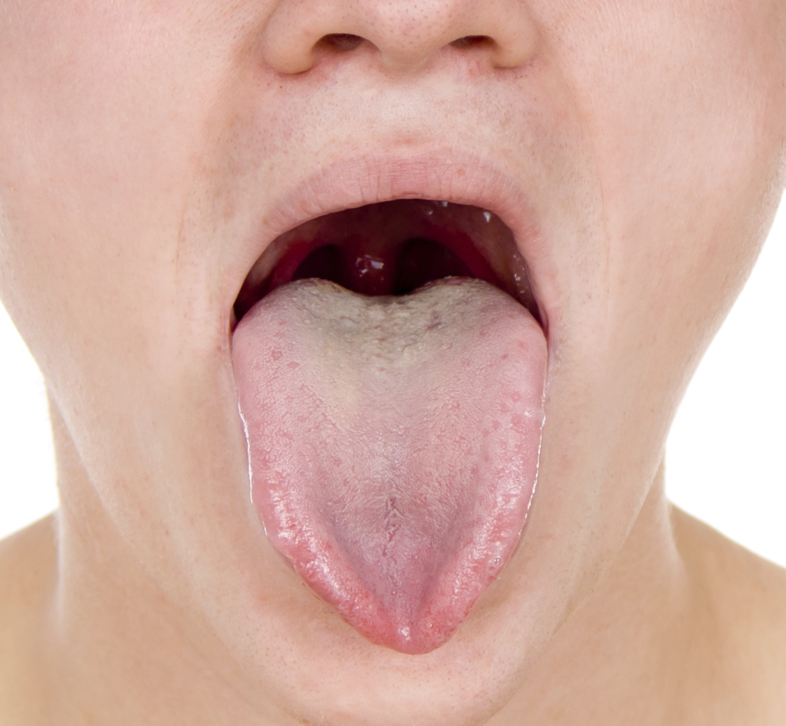 12-effective-remedies-for-treating-tongue-sores-healthspectra-youtube